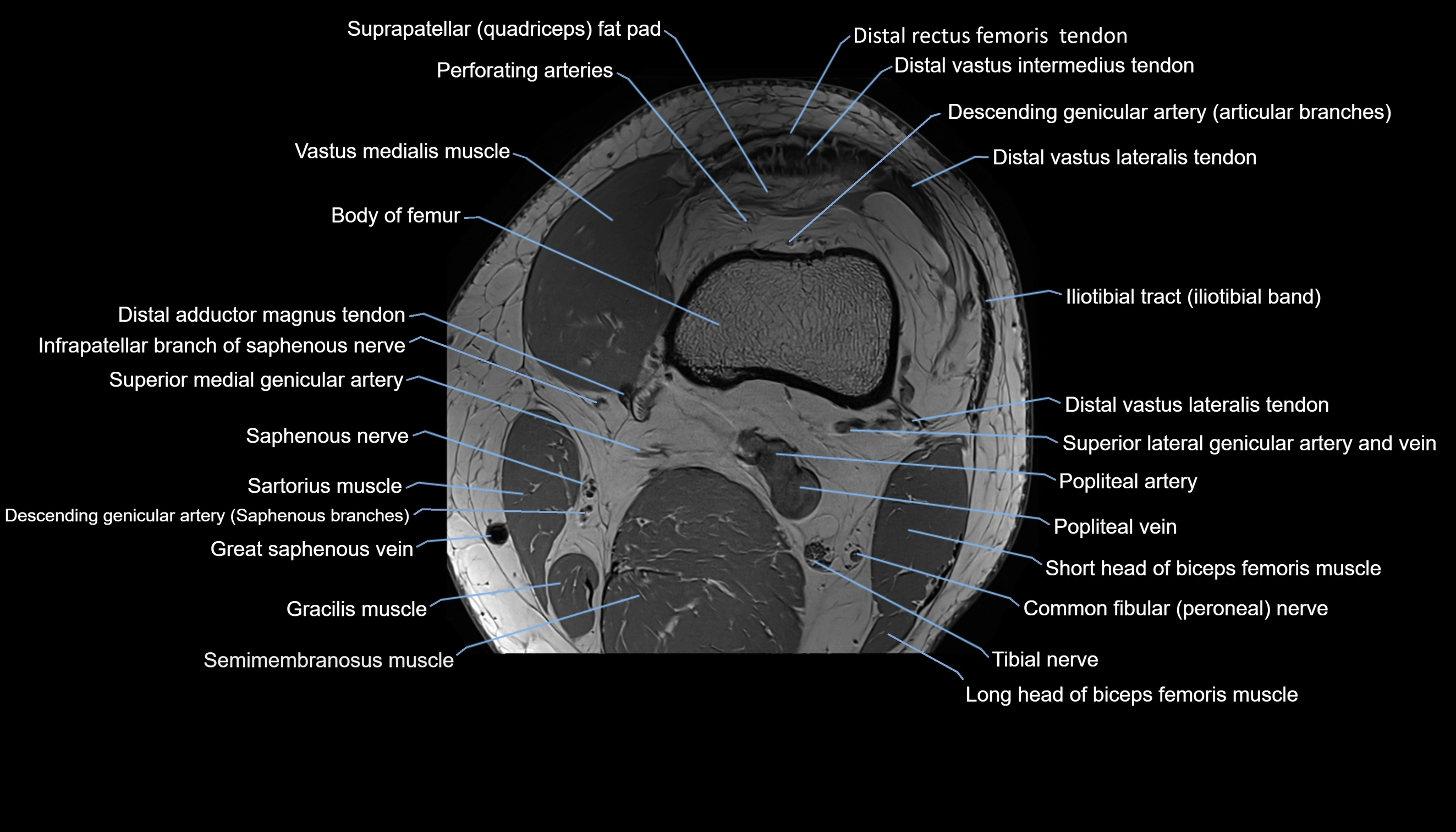 MRI knee  axial cross sectional anatomy 3T radiology  image-img-00001-00006.webp